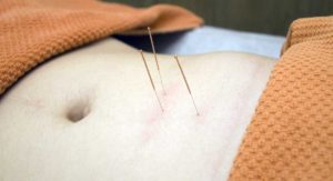 acupuntura na gestação