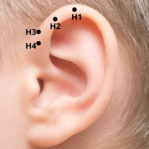 Pontos de auriculoterapia H1 a H4 no ápice da orelha