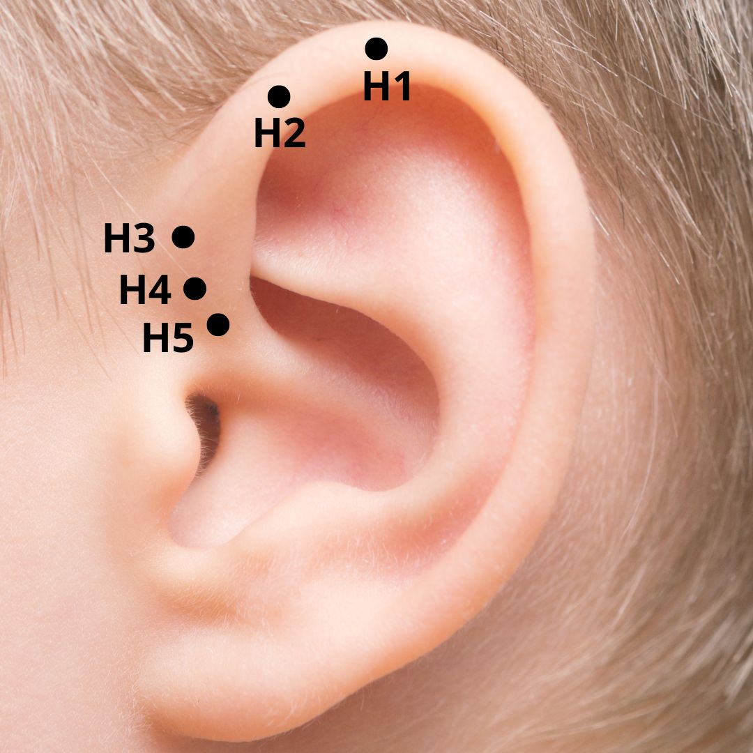 Ponto H5, localizado sobre a Hélix. Indicado para tratar: hemorróidas internas e externas, prolapso retal, incontinência fecal, enterites e disenterias bacilares.