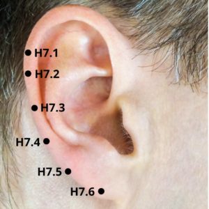 Pontos H7.1 até H7.6 da Hélix da Orelha